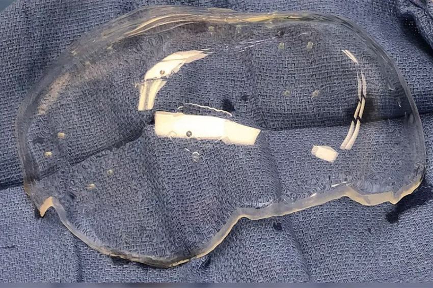 Ученые создали первый в мире имплантат черепа из прозрачного пластика