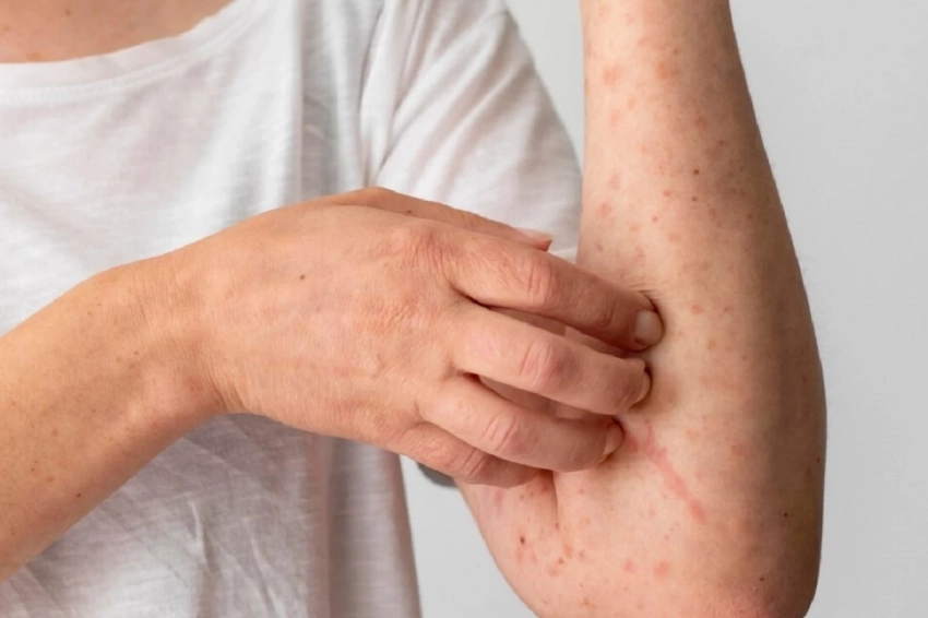 В Китае еще одна вспышка - нового штамма вируса оспы обезьян