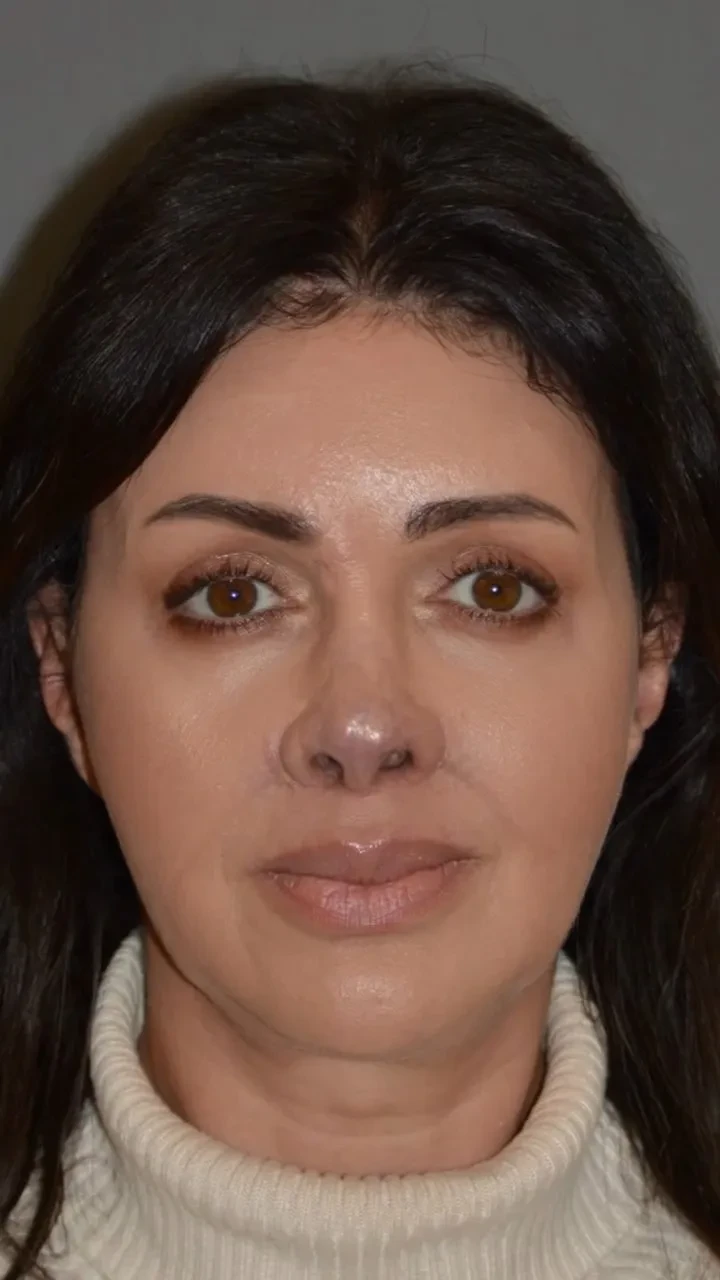 Бывшая жена Андрея Аршавина Алиса Казьмина завершила курс операций по восстановлению носа после болезни