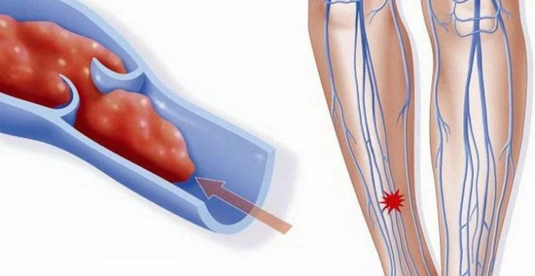 Тромб в организме: ключевые симптомы и сроки, о которых нужно знать