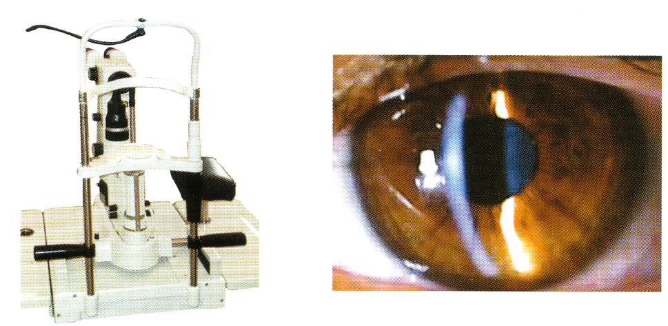 Методы иследовани яглаза. Биомикроскопия глазного дна. Биомикроскопия с щелевой лампой. Биомикроскопия с щелевой лампой. Биомикроскопия с щелевой лампой.
